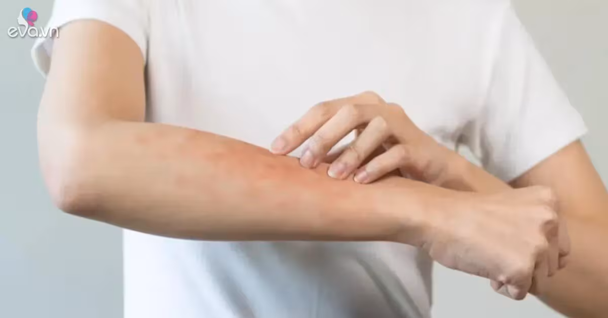 Cảnh báo sẩn ngứa do bọ chét bùng phát mùa nóng ẩm: Cách nhận biết và điều trị